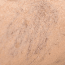 Sklerotherapie Besenreiser