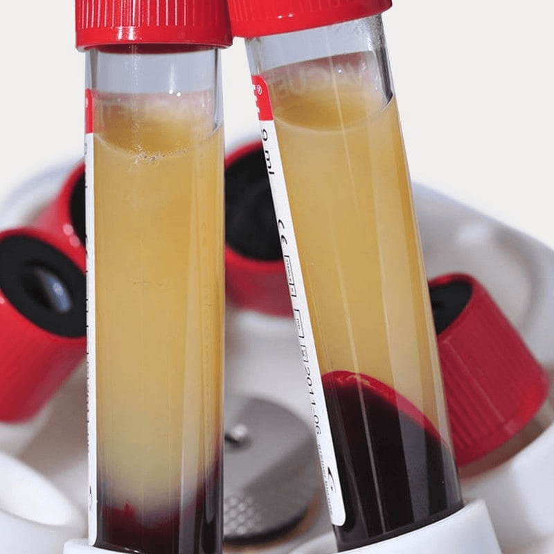 PRP (Plasma) Lift